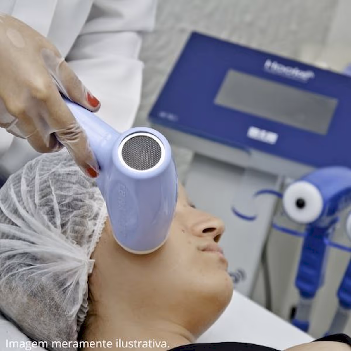 Radiofrequência para Rugas no Shopping Nova América